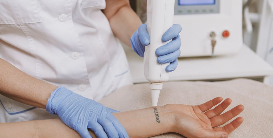 Errores comunes en tatuajes y cómo la tecnología láser puede corregirlos