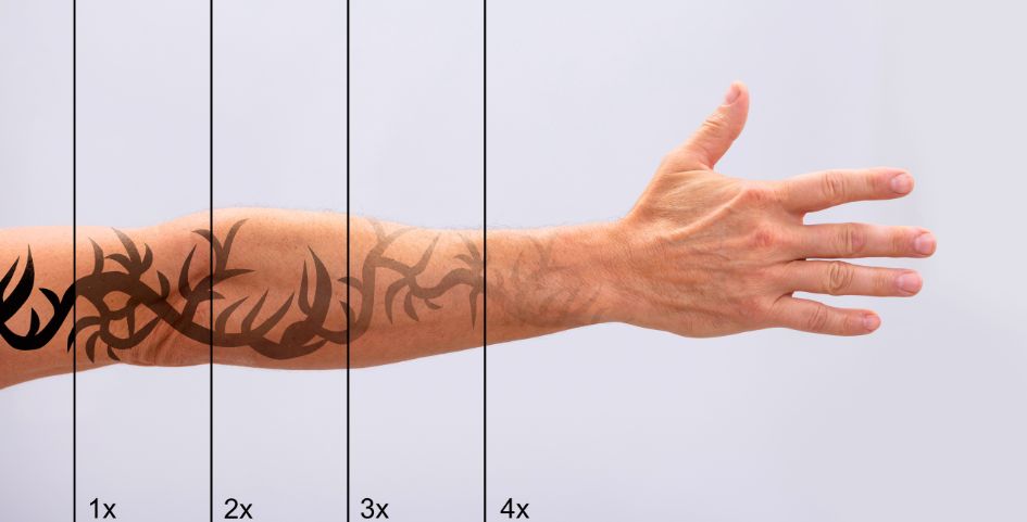 abandonas el tratamiento para borrar tatuajes