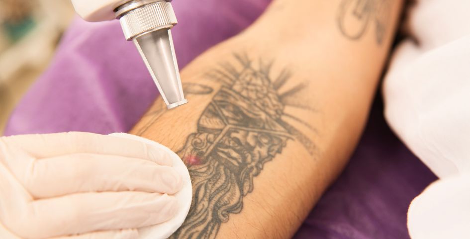 eliminación de tatuajes sin cicatrices