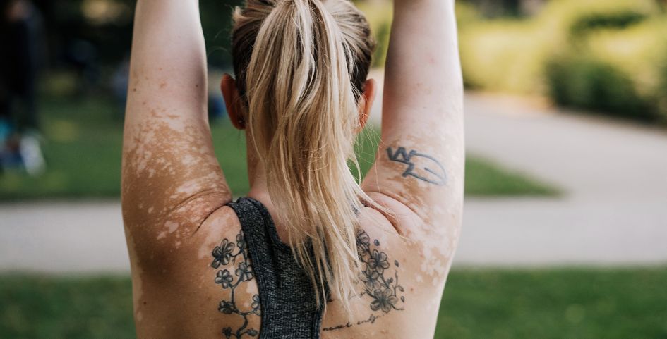 eliminar tatuajes con problemas dermatológicos