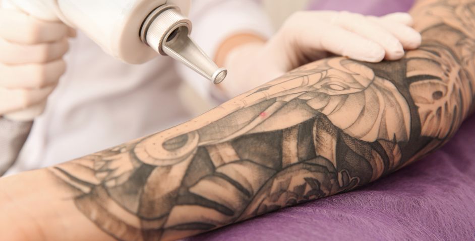 eliminación tatuajes diferentes tipos de piel