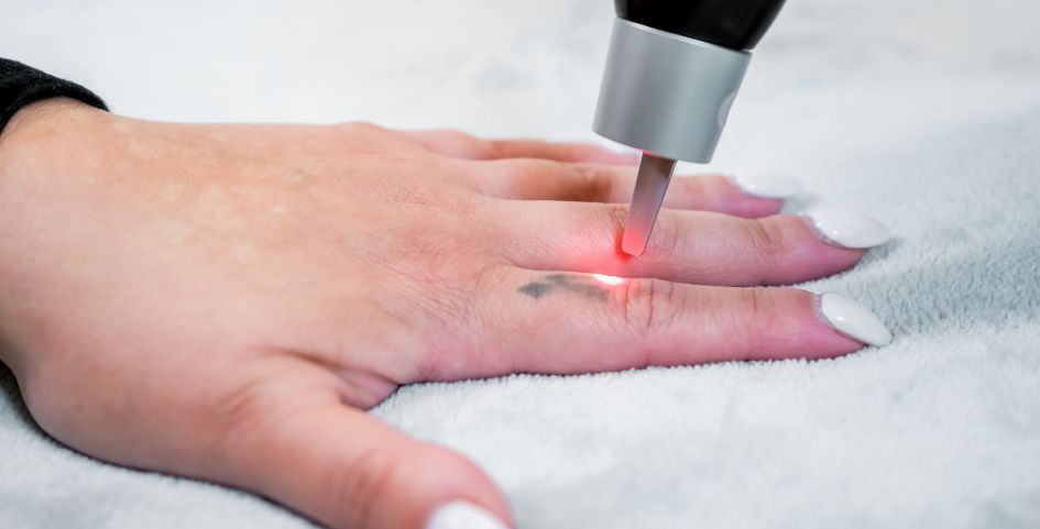 Eliminación de tatuajes en zonas delicadas