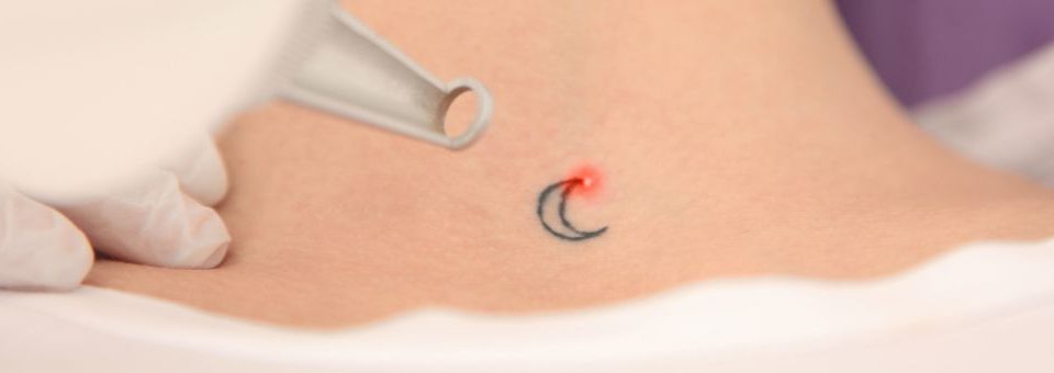 evolucion tecnologia laser