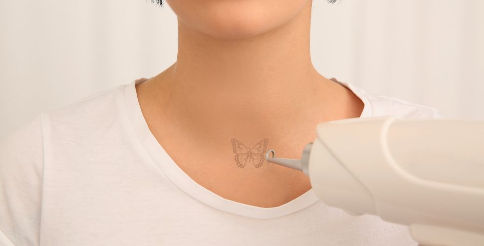 borrar tatuaje con tinta blanca