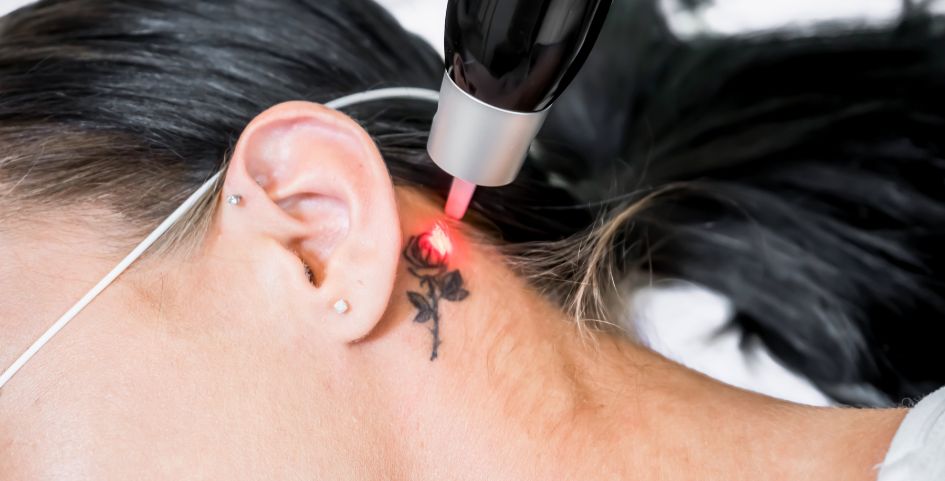eliminar tatuajes con tinta fluorescente